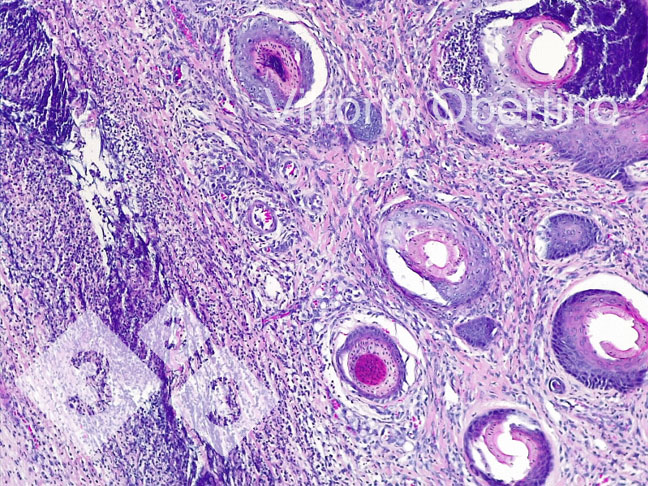 Figure 8. Nombril. Zone dermique localement &eacute;tendue constitu&eacute;e de fibroplasie avec fibroblastes activ&eacute;s et de nombreux petits vaisseaux immatures (tissu de granulation nouvellement form&eacute;), infiltrat inflammatoire multifocal avec une pr&eacute;dominance de cellules lymphop