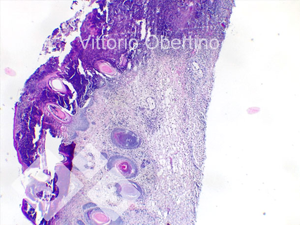 Figure 9. Peau. &Eacute;rosion &eacute;pith&eacute;liale focale dans laquelle la couche superficielle est remplac&eacute;e par un mat&eacute;riel &eacute;osinophile amorphe &agrave; granulaire abondant avec des d&eacute;bris cariorectiques (n&eacute;crose) et des granulocytes neutrophiles d&eacute;g